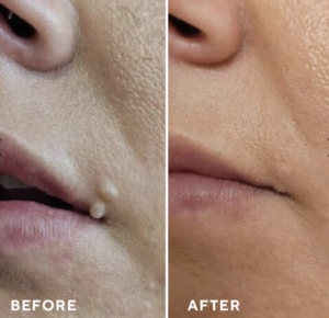 Before and after Cryotherapy